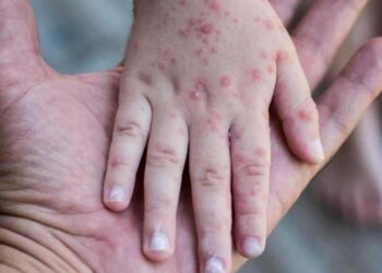 Kızamıkta korkutan vaka sayısı artışı: 27 yıl sonra en yüksek sayıda