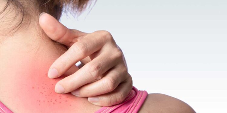 Boynu Kızardı Diye Doktora Gitti, Derisinin Altından Solucan Çıktı!