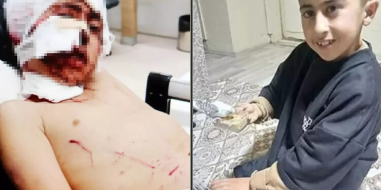 Erzurum’da bakkala giderken köpeklerin saldırısına uğrayan çocuk yaralandı