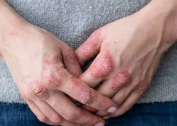 Karın Yağlanmasıyla Bağlantısı Tespit Edildi