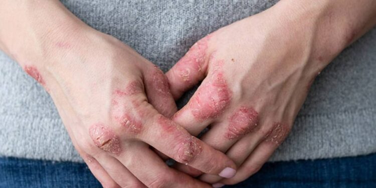 Karın Yağlanmasıyla Bağlantısı Tespit Edildi