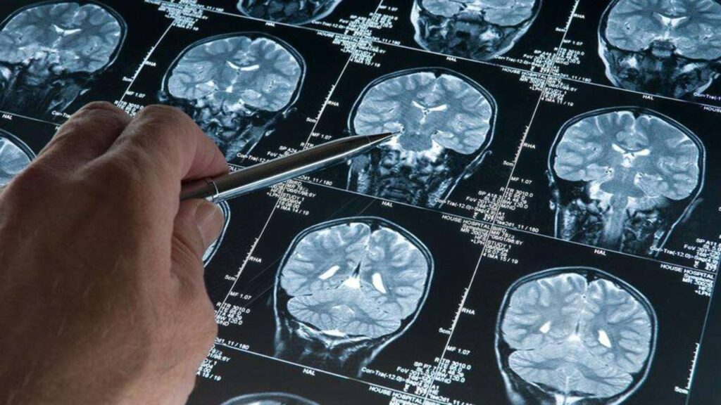 Alzheimer Tedavisinde Devrim Niteliğinde Buluş! Yüzde 95 Oranında Tespit Edebiliyor
