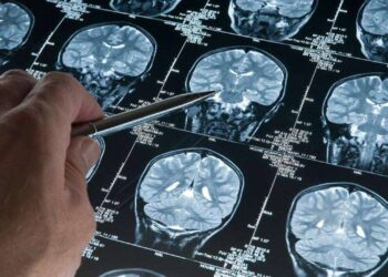 Alzheimer Tedavisinde Devrim Niteliğinde Buluş! Yüzde 95 Oranında Tespit Edebiliyor