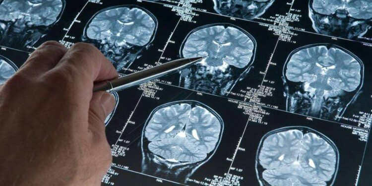 Alzheimer Tedavisinde Devrim Niteliğinde Buluş! Yüzde 95 Oranında Tespit Edebiliyor