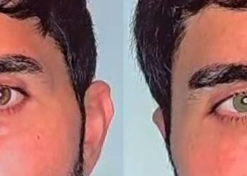 Mavi mi, Yeşil mi? Lazerle Göz Rengini Değiştirme Dönemi Başladı