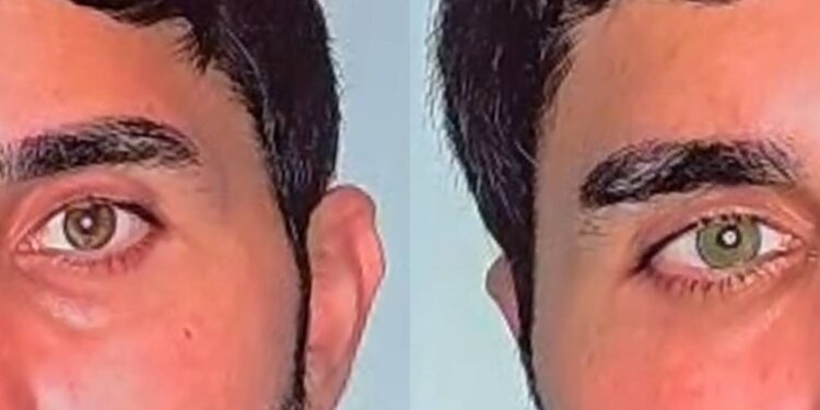 Mavi mi, Yeşil mi? Lazerle Göz Rengini Değiştirme Dönemi Başladı