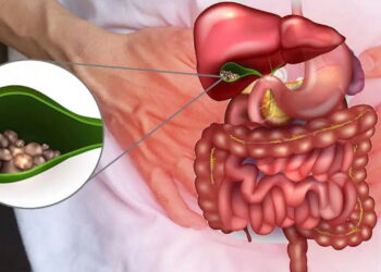 Safra kesesi ameliyatlarının artmasının nedeni zayıflama iğneleri olabilir