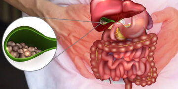 Safra kesesi ameliyatlarının artmasının nedeni zayıflama iğneleri olabilir