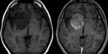 Beyin kanserinde yıllardır süren çıkmazda kritik gelişme: Sağlıklı dokuya zarar vermeden yok ediyor