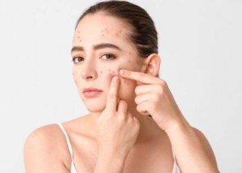 Cilt sağlığında göz ardı edilen gerçek: Sivilce oluşumunu tetikleyen 5 besin