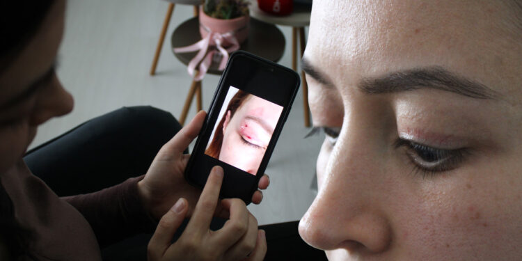 Güzellik Merkezi Kabusu! 1100 Liraya Yaptırdı, 150 Bin Liraya Düzeltilemiyor