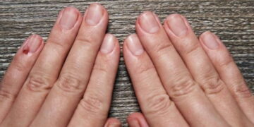 Ayak tırnağınızdaki o detaya dikkat: Sessizce yayılan kanserin habercisi olabilir!