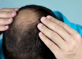 Bilim insanları açıklıyor: Kellik gerçekten genetik mi?