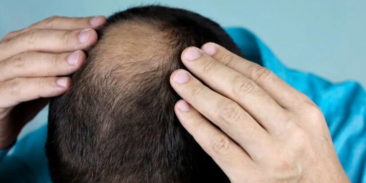 Bilim insanları açıklıyor: Kellik gerçekten genetik mi?