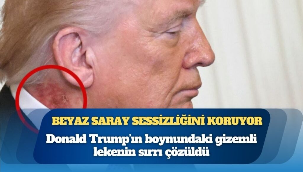 Donald Trump’ın boynundaki gizemli lekenin sırrı çözüldü