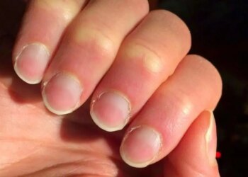 Tırnaklardaki sessiz uyarı: Hangi değişim hangi hastalığın habercisi?