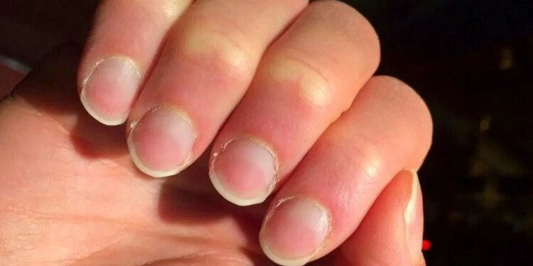 Tırnaklardaki sessiz uyarı: Hangi değişim hangi hastalığın habercisi?