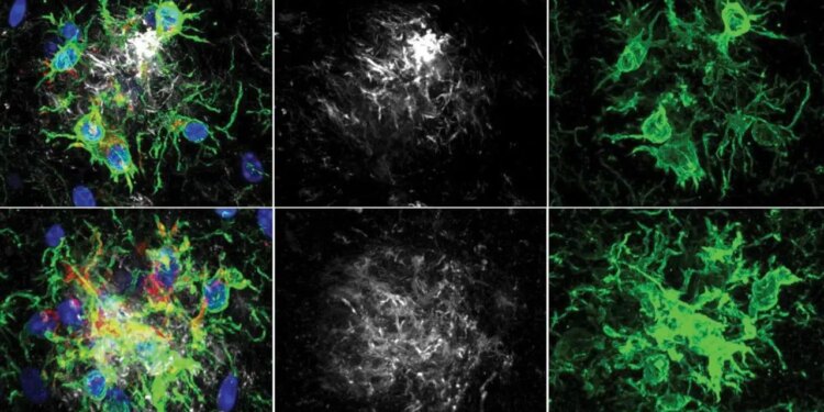 Alzheimer tedavisinde yeni ufuk: Beynin ‘temizlik ekibi’ yeniden programlandı