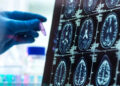 Alzheimer’da 'Gizli Evre' Deşifre Oldu: 50'li Yaşların Sonuna Dikkat