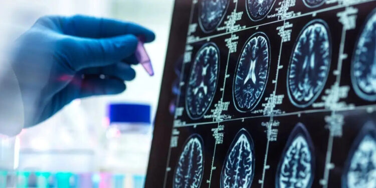 Alzheimer’da 'Gizli Evre' Deşifre Oldu: 50'li Yaşların Sonuna Dikkat