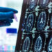 Alzheimer’da 'Gizli Evre' Deşifre Oldu: 50'li Yaşların Sonuna Dikkat