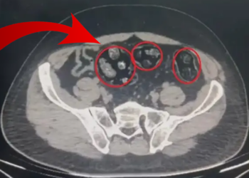Mide ve Bağırsaklarından Çıkanlar Şok Etti! 62 Parça Halinde Tam 502 Gram...