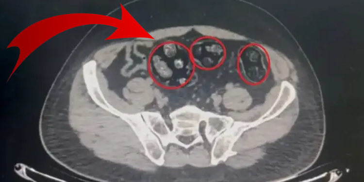 Mide ve Bağırsaklarından Çıkanlar Şok Etti! 62 Parça Halinde Tam 502 Gram...