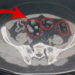 Mide ve Bağırsaklarından Çıkanlar Şok Etti! 62 Parça Halinde Tam 502 Gram...