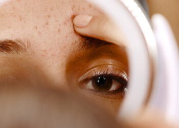 Yüzünüzdeki Kahverengi Lekelerin Tek Suçlusu Güneş Değil! Dermatolog Uyardı