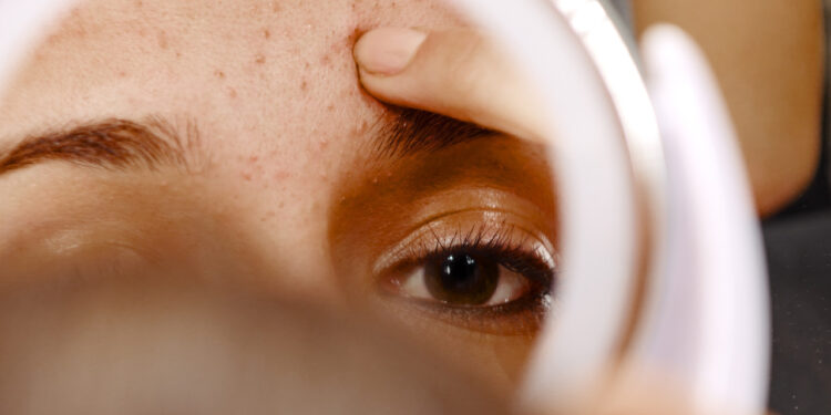 Yüzünüzdeki Kahverengi Lekelerin Tek Suçlusu Güneş Değil! Dermatolog Uyardı