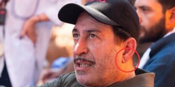 Cem Yılmaz’ın rahatsızlığı sonrası yeniden gündemde: Kulak memesindeki ‘Frank işareti’ ne anlama geliyor?