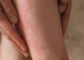 ‘Çilek bacak’ görünümüne dikkat: Yanlış peeling cildi tahriş edebilir